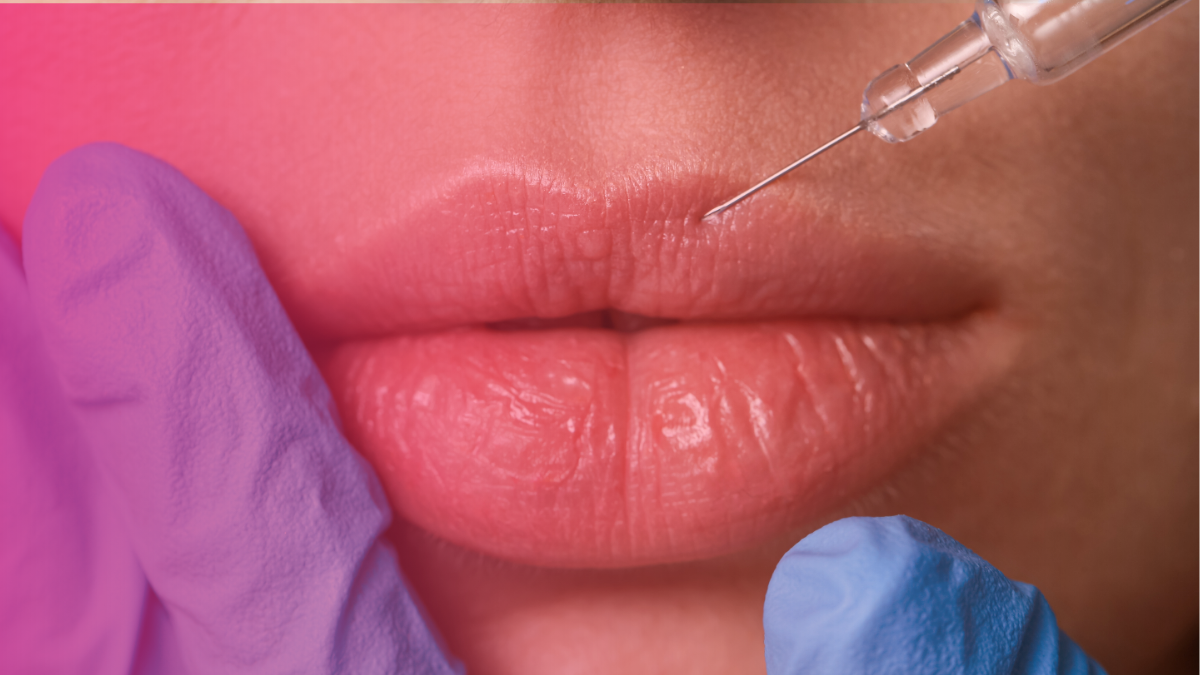 Is 0.5 ml lip filler worth it?