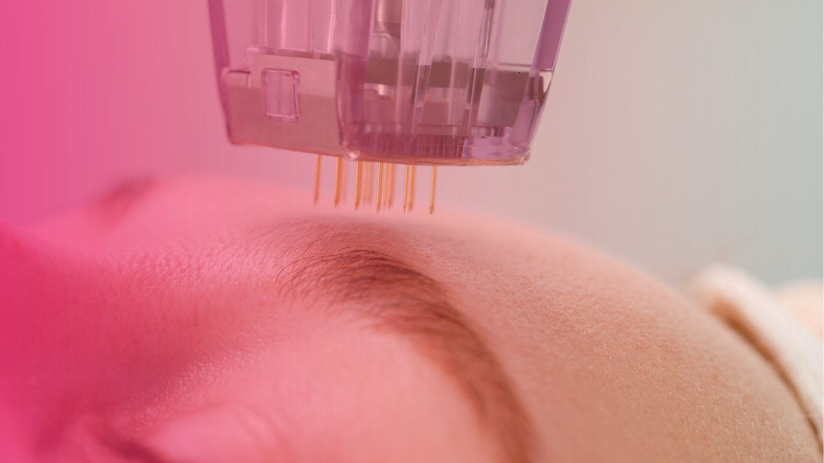10 Things Nobody Tells You About Microneedling