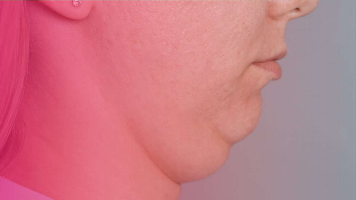 How Much Does Kybella Cost, and Is It the Right Double Chin Treatment for You?