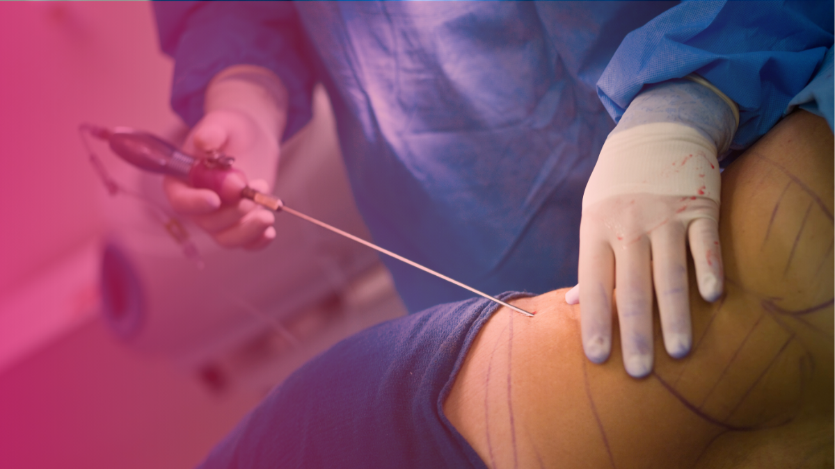 Is liposuction worth the money?