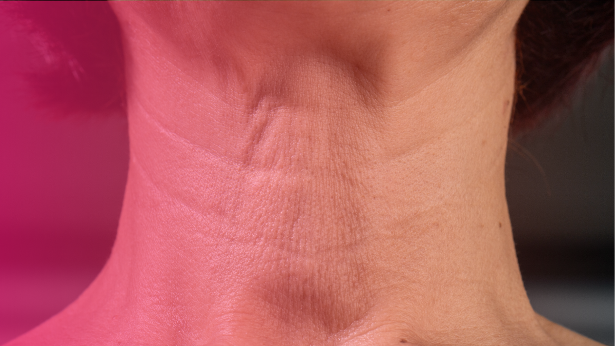 Can You Have a Neck Lift Without a Facelift?